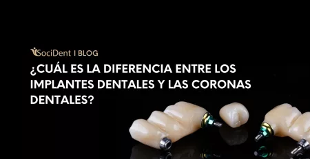 Diferencia entre coronas dentales y implantes dentales